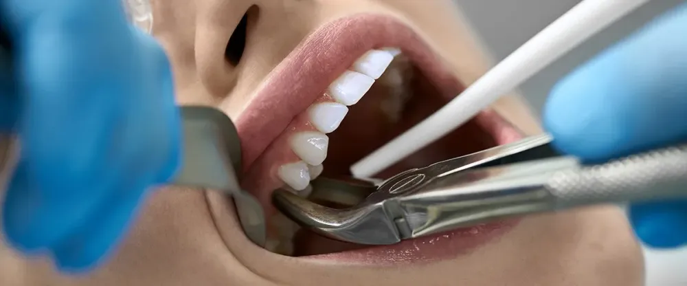 Удаление зуба: что нужно знать