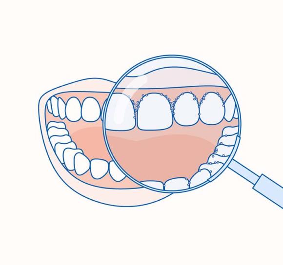 Кровоточивость десен – это первый признак воспаления