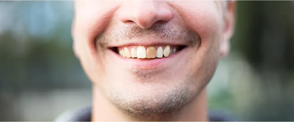 Предотвратить эрозию зубов: Как защитить свою эмаль