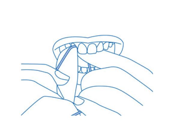 Атравматичная техника чистки дентальной нитью