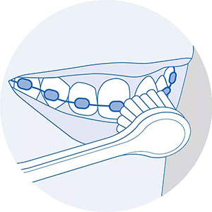 Правильная чистка зубов звуковой зубной щеткой