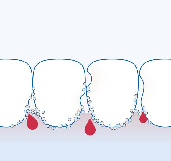 Кровоточивость десен – это первый признак воспаления